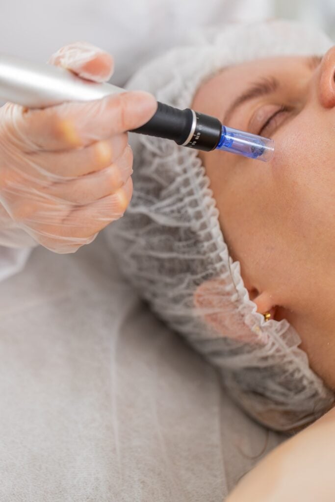 Microneedling Vertical