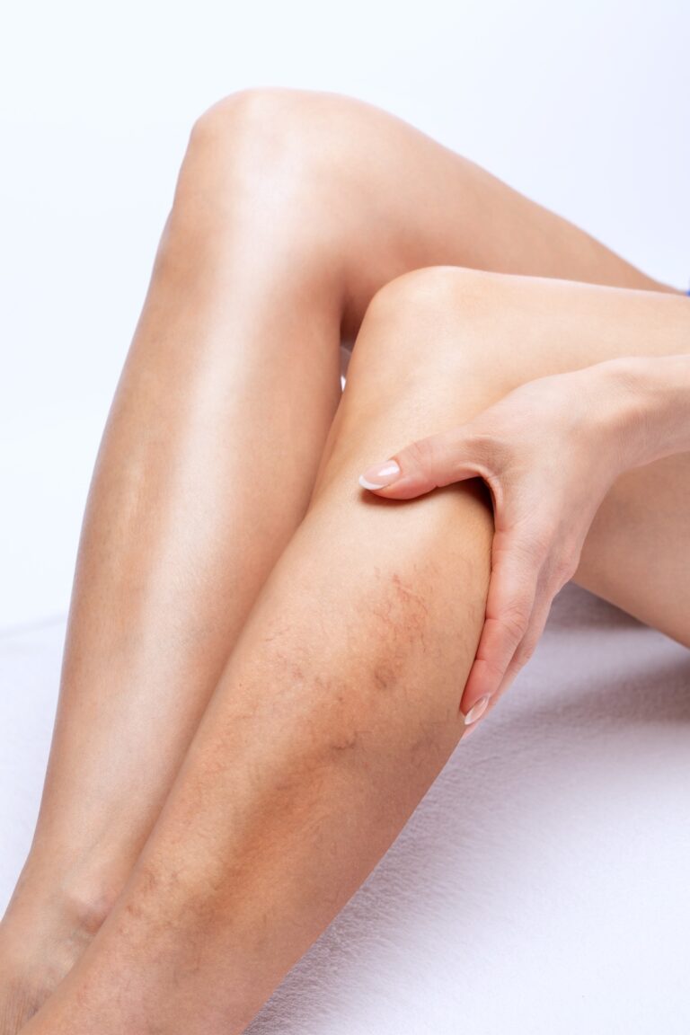 Sclerotherapy