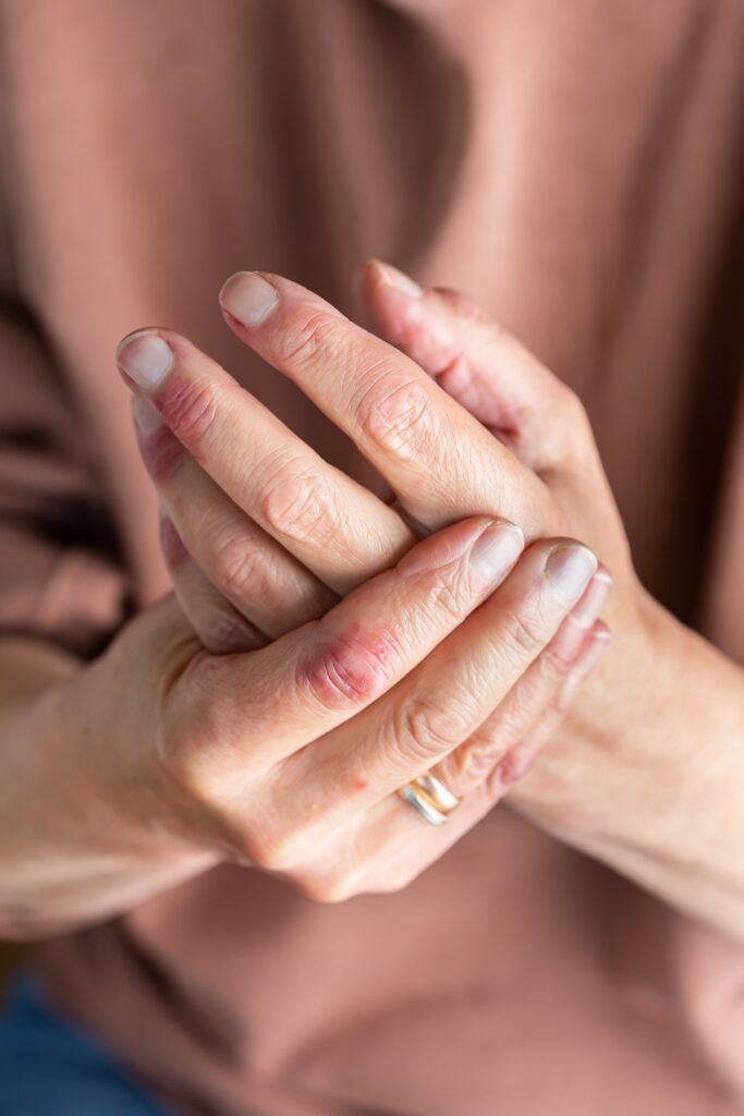 Skin Conditions - Acne, Eczema, Psoriasis