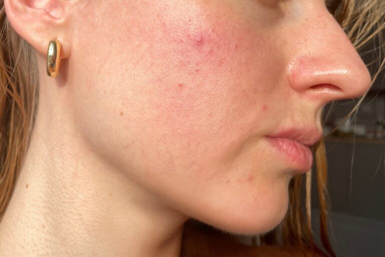 Why Am I Breaking Out After a Facial?